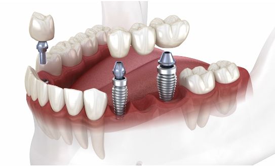 Implante dental de mas de un diente