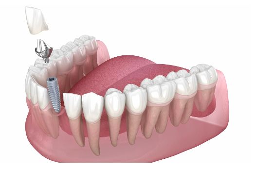 Implante dental de solo un diente