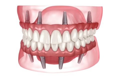 Implante dental de todos los dientes